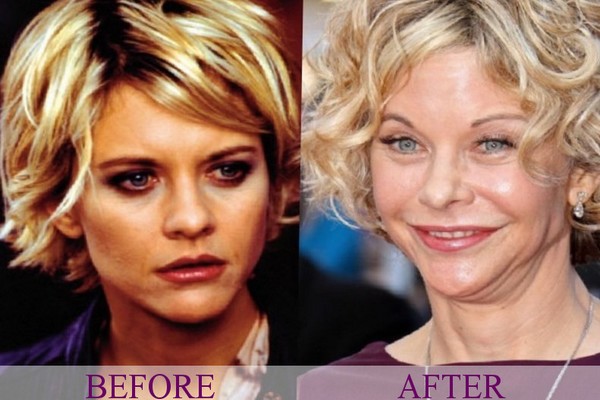 10 Times Plastic Surgery went Horribly wrong for Celebrities